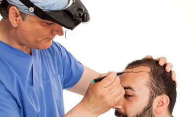 تركيا.. الوجهة الأمثل لزراعة الشعر لأسباب عدة